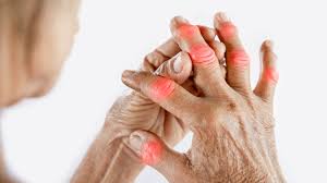 What is Arthritis? Explore the Variations in Treatment Approaches for Different Age Groups