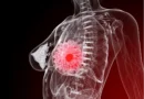 Breast cancer hormone therapy and dementia risk